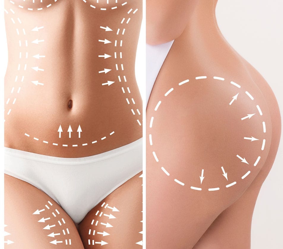 Laser Stretch Mark Removal: Toronto Laser Treatment For Stretch Marks