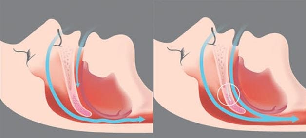 sleep-apnea