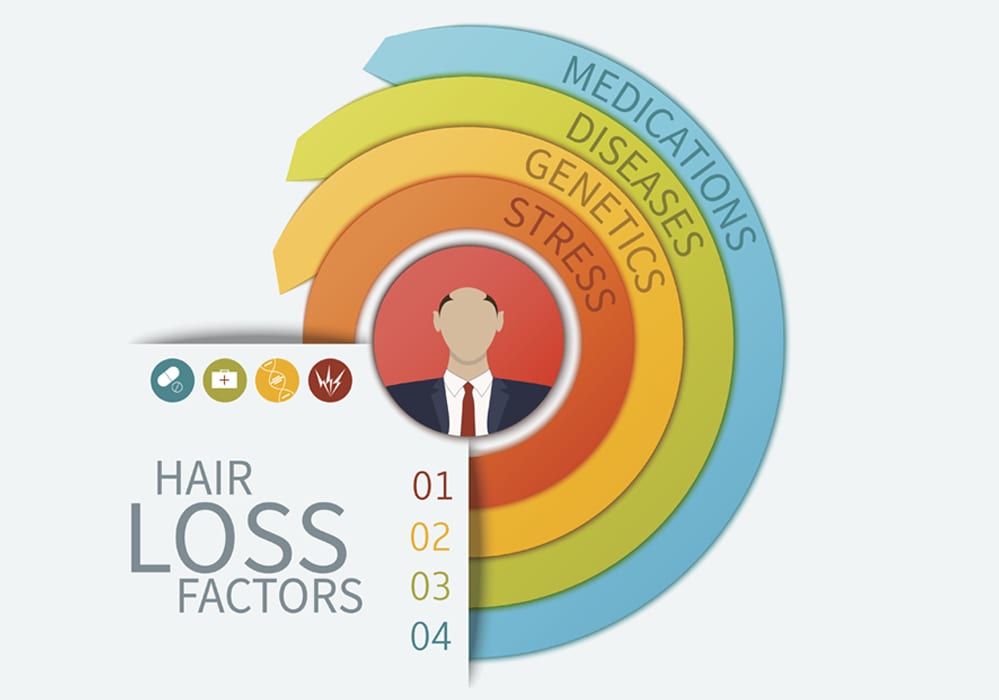 INFOGRAPHIC HAIRLOSS MAN